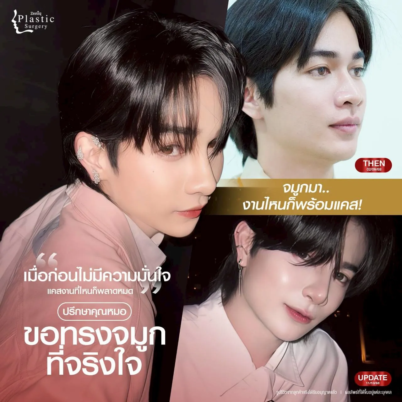 เสริมจมูกแบบ Open ที่ Zeniq Plastic Surgery
