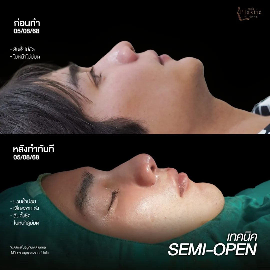 เสริมจมูกแบบ Semi Open ที่ Zeniq Plastic Surgery